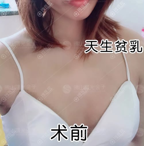 佛山曙光金子宋仁刚做假体隆胸归来 看我花2W植入250cc假体效果