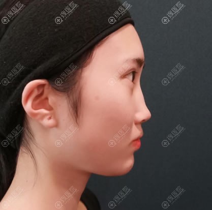 看苏州前十名的整形医院排行榜上有薇琳医美,就去薇琳做隆鼻了