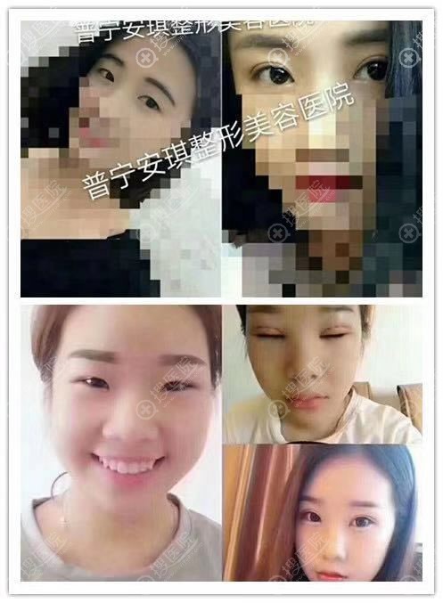 2、普宁安琪医院林登文双眼皮案例 2、普宁安琪医院林登文双眼皮案例
