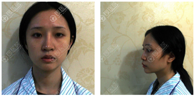 找福州格莱美钟德成做完隆鼻子后感觉院长技术和审美都很不错哦