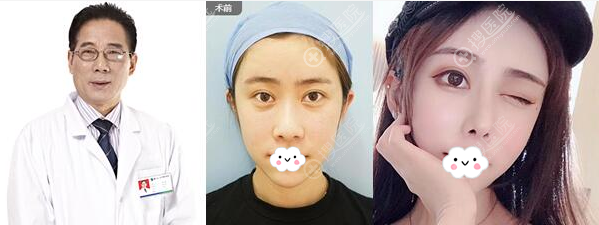 佛山曙光金子何宜新隆鼻怎么样?看真实案例 佛山曙光金子何宜新隆鼻怎么样?看真实案例