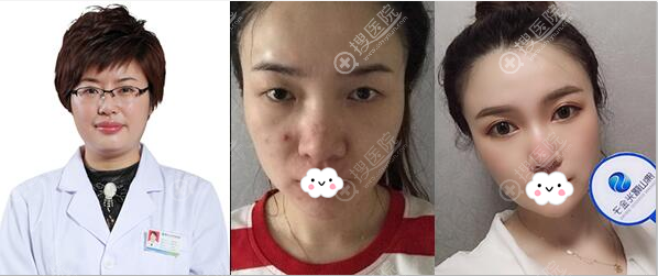 佛山曙光金子李淑薇切开双眼皮案例 佛山曙光金子李淑薇切开双眼皮案例