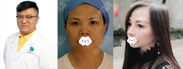 佛山曙光金子宋仁刚鼻综合前后对比 佛山曙光金子宋仁刚鼻综合前后对比