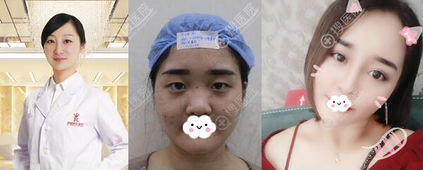 佛山梦露孙文娜眼综合案例 佛山梦露孙文娜眼综合案例