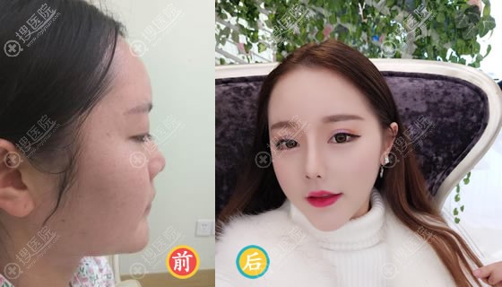 <!--<i data=20240710 data-id=12457></i>-->陶波鼻综合隆鼻案例 <!--<i data=20240710 data-id=12457></i>-->陶波鼻综合隆鼻案例