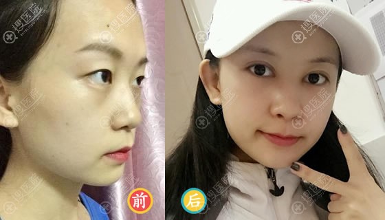 <!--<i data=20240710 data-id=12457></i>-->葛茸茸双眼皮开眼角案例 <!--<i data=20240710 data-id=12457></i>-->葛茸茸双眼皮开眼角案例