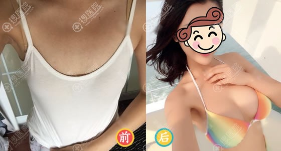 <!--<i data=20240710 data-id=12457></i>-->陶波假体隆胸案例 <!--<i data=20240710 data-id=12457></i>-->陶波假体隆胸案例