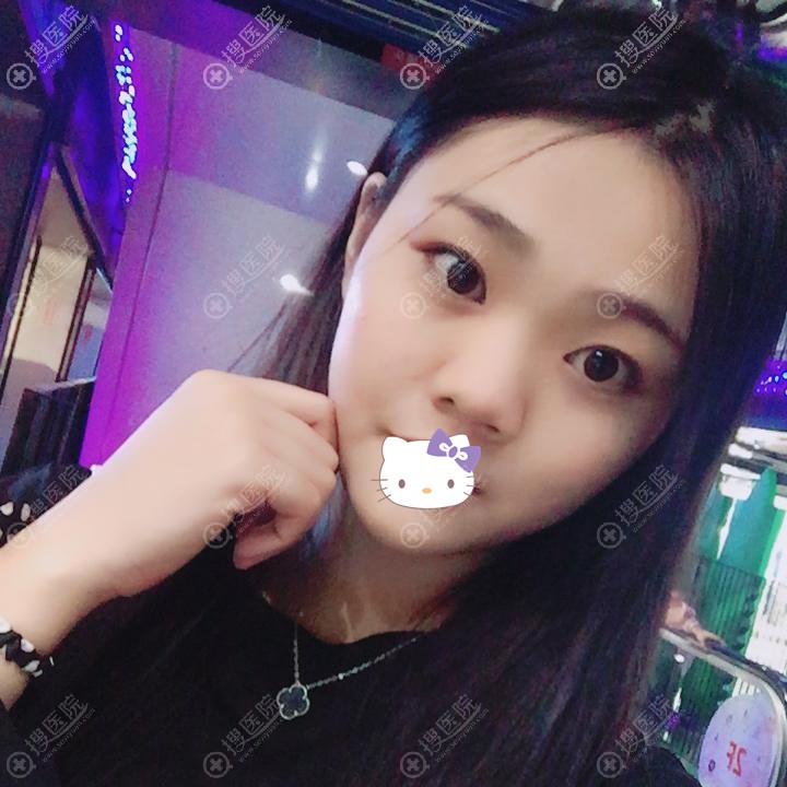 到广州韩妃做了鼻翼缩小术后的恢复经历,大家看有没有改变