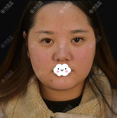 距离我找苏州薇琳狄峰做面部吸脂减肥2个月了,毕竟漂亮才是王道