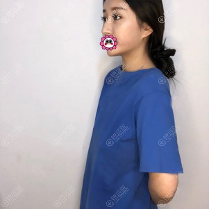 一起来看我在广州画美找牟北平做的假体隆胸恢复三个月效果如何