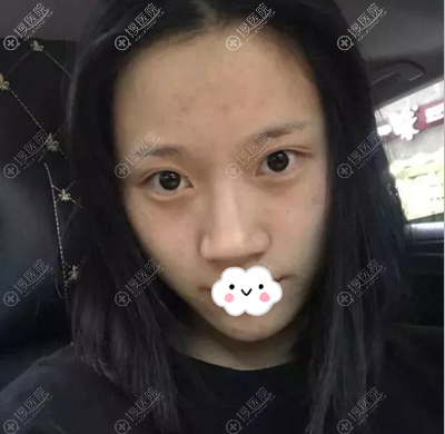 成都陈荣亮隆鼻术前照片 成都陈荣亮隆鼻术前照片