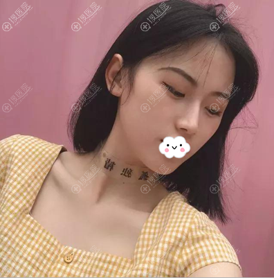 <!--<i data=20240710 data-id=12057></i>-->陈荣亮隆鼻效果展示 <!--<i data=20240710 data-id=12057></i>-->陈荣亮隆鼻效果展示