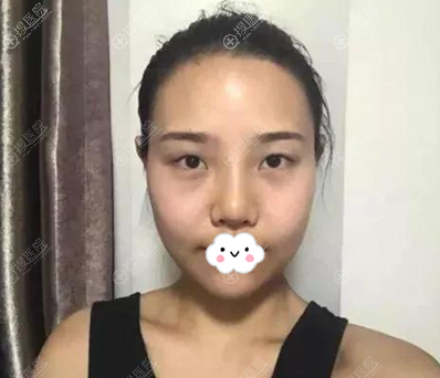 陈荣亮鼻综合术前照片 陈荣亮鼻综合术前照片