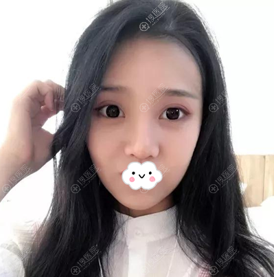 <!--<i data=20240710 data-id=12057></i>-->陈荣亮鼻综合术后效果 <!--<i data=20240710 data-id=12057></i>-->陈荣亮鼻综合术后效果