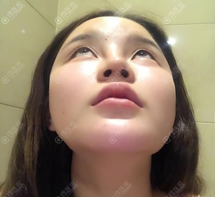 假体隆鼻后出现感染症状,赶紧来北京薇琳找王小东做了鼻修复