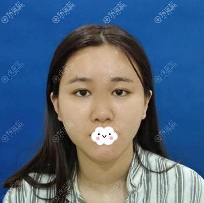 厦门华美陈运生做双眼皮不错,看他做的鼻综合手术术后效果如何