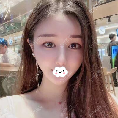 厦门华美陈运生鼻综合术后一年恢复效果 厦门华美陈运生鼻综合术后一年恢复效果