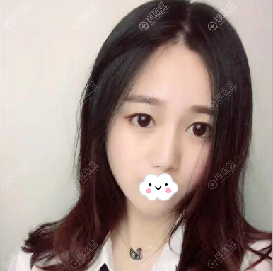 陈运生硅胶隆鼻术后一个月 陈运生硅胶隆鼻术后一个月