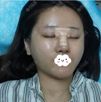 厦门华美陈运生隆鼻术后即刻照片 厦门华美陈运生隆鼻术后即刻照片
