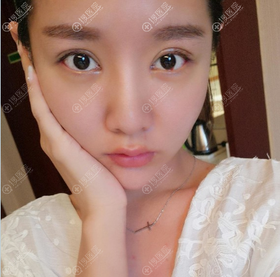 无锡<!--<i data=20240710 data-id=1918></i>-->彭建双眼皮5天消肿 无锡<!--<i data=20240710 data-id=1918></i>-->彭建双眼皮5天消肿