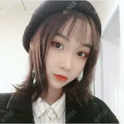 鼻综合隆鼻术后5天恢复效果图 鼻综合隆鼻术后5天恢复效果图