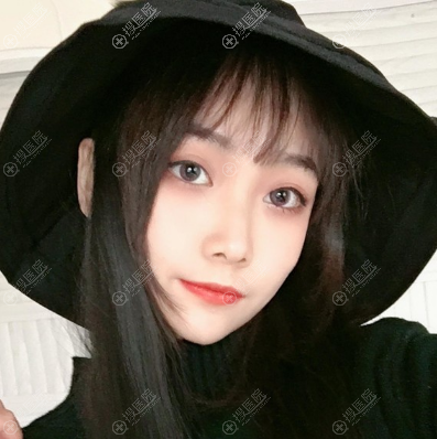 合肥壹美尚<!--<i data=20240710 data-id=16581></i>-->做的隆鼻手术案例 合肥壹美尚<!--<i data=20240710 data-id=16581></i>-->做的隆鼻手术案例