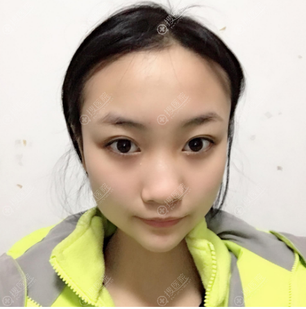 好不容易才在合肥壹美尚整形医院找到唐振利为我做了隆鼻子手术