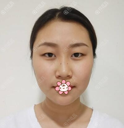 ��˫��Ƥ��ǰ������Ƭ