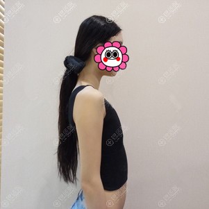 参加苏州薇琳胸模活动有幸被选中做假体隆胸三个月后女人味十足