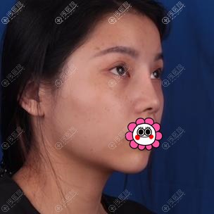 之前做过硅胶隆鼻效果不好,到成都华人医联用耳软骨做了鼻修复