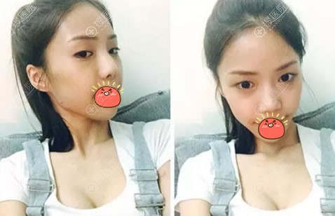 济南集美整形医院双眼皮隆鼻案例 网红主播分享眼鼻打造攻略