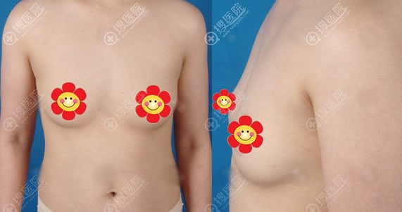 锦州斯美诺做假体隆胸术前 锦州斯美诺做假体隆胸术前