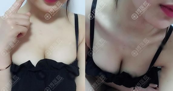 锦州斯美诺耿成虎假体隆胸案例 锦州斯美诺耿成虎假体隆胸案例