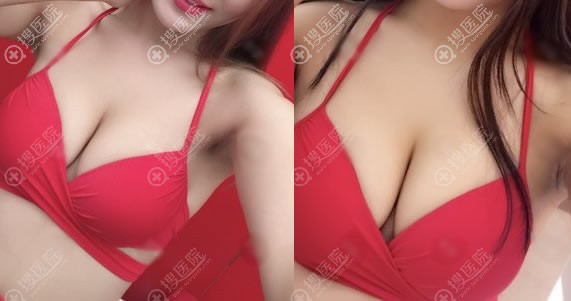 锦州斯美诺医院假体隆胸案例 锦州斯美诺医院假体隆胸案例
