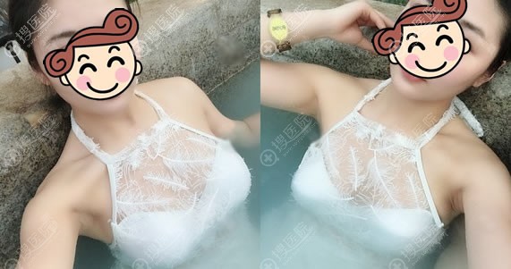 锦州斯美诺假体隆胸案例2年效果 锦州斯美诺假体隆胸案例2年效果