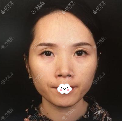 深圳美莱徐占峰自体脂肪面部二次填充术后一个月基本不肿了
