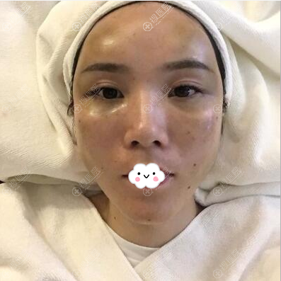 ����֬���沿�������3��