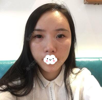 ��ռ������֬���沿���10��