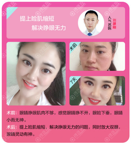 保定京都皮肤美容医院刘建刚双眼皮案例 保定京都皮肤美容医院刘建刚双眼皮案例