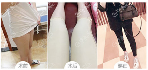 保定京都整形医院大腿吸脂案例 保定京都整形医院大腿吸脂案例