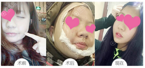 保定京都皮肤美容医院面部吸脂案例 保定京都皮肤美容医院面部吸脂案例