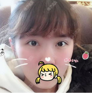<!--<i data=20240710 data-id=11606></i>-->医院整形科孙宇医生双眼皮案例 <!--<i data=20240710 data-id=11606></i>-->医院整形科孙宇医生双眼皮案例