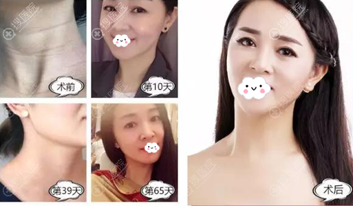 <!--<i data=20240710 data-id=12503></i>-->脂肪改善颈纹案例 <!--<i data=20240710 data-id=12503></i>-->脂肪改善颈纹案例