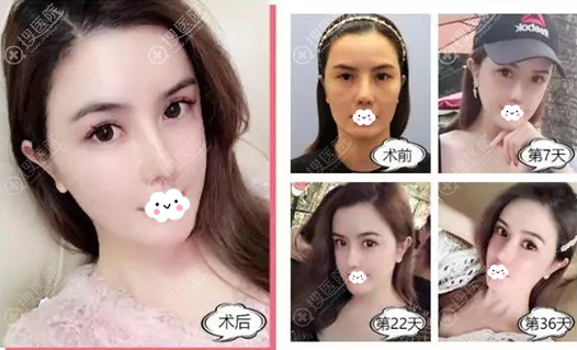 <!--<i data=20240710 data-id=12503></i>-->石东文脂肪胶改善肤质抚平细纹案例 <!--<i data=20240710 data-id=12503></i>-->石东文脂肪胶改善肤质抚平细纹案例
