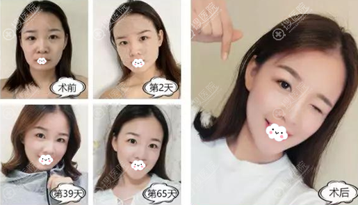 <!--<i data=20240710 data-id=12503></i>-->脂肪填充额头太阳穴+丰下巴术后效果 <!--<i data=20240710 data-id=12503></i>-->脂肪填充额头太阳穴+丰下巴术后效果