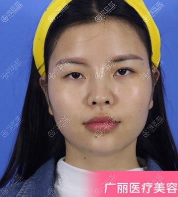 真人真事,南宁广丽整形做耳软骨鼻综合隆鼻和双眼皮的案例效果