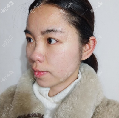 你只知上海美联臣刘先超磨骨做得好,却不知他隆鼻做得也超自然