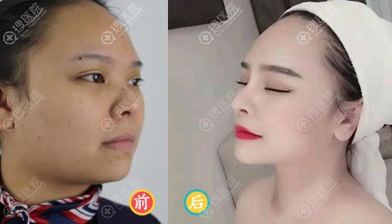 赣州华美方贤成鼻综合隆鼻案例 赣州华美方贤成鼻综合隆鼻案例