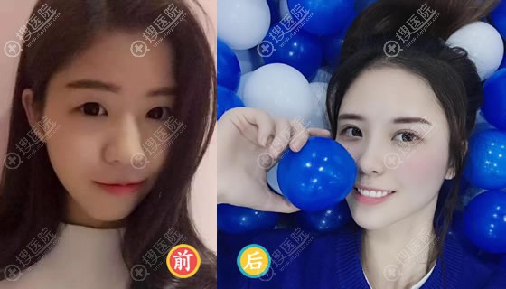 赣州华美方贤成双眼皮案例 赣州华美方贤成双眼皮案例