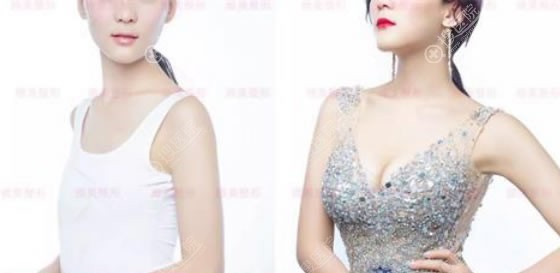 赣州华美方贤成假体隆胸手术案例 赣州华美方贤成假体隆胸手术案例